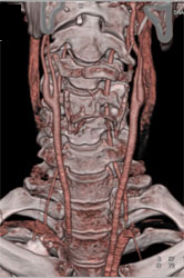 Carotid Stenosis - CTisus CT Scan