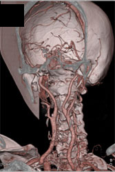 Carotid Stenosis - CTisus CT Scan