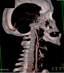 Carotid Stenosis - CTisus CT Scan