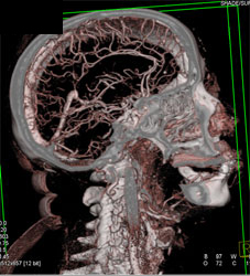 Intracerebral CTA - CTisus CT Scan