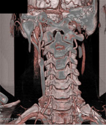 Patent Vertebral Artery - CTisus CT Scan