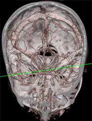 Base of Skull in CTA - CTisus CT Scan