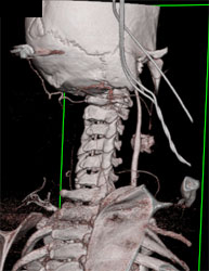 Extravasation From Injured Carotid Artery - CTisus CT Scan