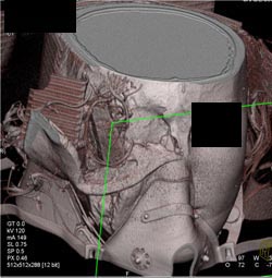 Horrible Trauma to Face-skin Lifted Away - CTisus CT Scan