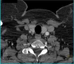 Takayasu's Arteritis - See Right Carotid Artery - CTisus CT Scan