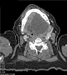 Cyst Base of Tongue - CTisus CT Scan