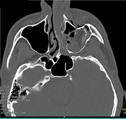 Orbital Fracture - CTisus CT Scan