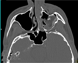 Orbital Fracture - CTisus CT Scan