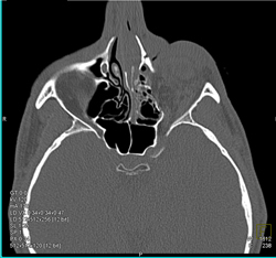 Orbital Fracture - CTisus CT Scan