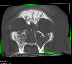 Orbital Fracture - CTisus CT Scan