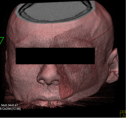 Orbital Fracture - CTisus CT Scan