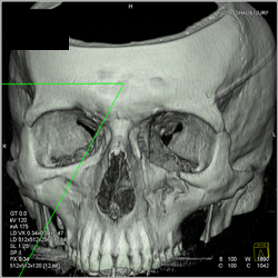 Orbital Fracture - CTisus CT Scan