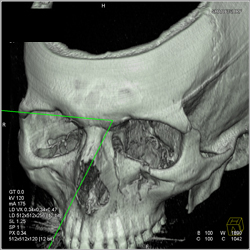 Orbital Fracture - CTisus CT Scan