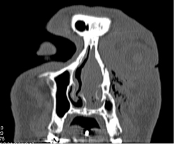 Orbital Fracture - CTisus CT Scan