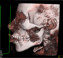 Orbital Edema S/P Trauma - CTisus CT Scan