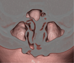 Sinusitis - CTisus CT Scan