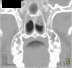 Sinusitis - CTisus CT Scan