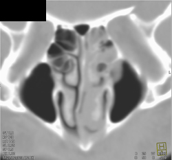 Sinusitis - CTisus CT Scan