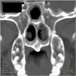 Sinusitis - CTisus CT Scan