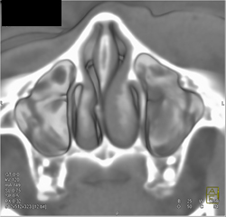 Sinusitis - CTisus CT Scan