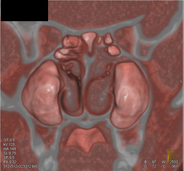 Sinusitis - CTisus CT Scan