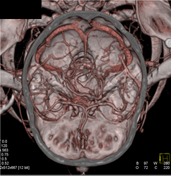 Ectatic Basilar Artery in Loeys-Dietz Syndrome - CTisus CT Scan