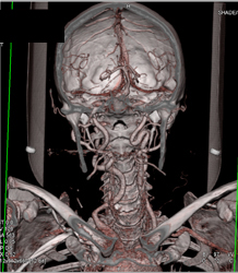 Ectatic Carotid Artery in Loeys-Dietz Syndrome - CTisus CT Scan