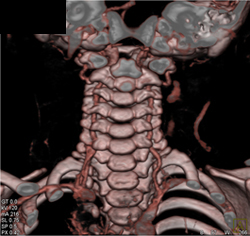 Normal Anatomy W/ Various Renderings - CTisus CT Scan