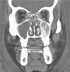 Sinusitis - CTisus CT Scan