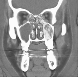 Sinusitis - CTisus CT Scan