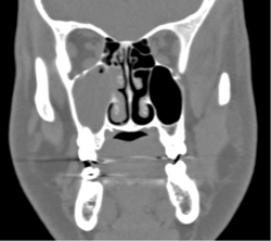 Sinusitis - CTisus CT Scan