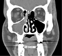 Sinusitis - CTisus CT Scan