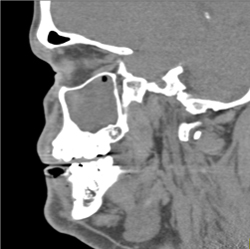 Sinusitis - CTisus CT Scan