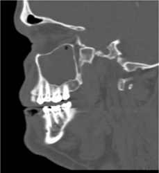 Sinusitis - CTisus CT Scan