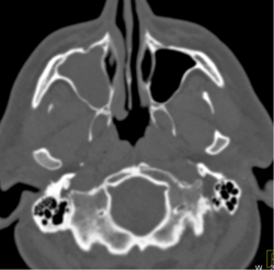 Sinusitis - CTisus CT Scan