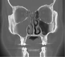 Sinusitis - CTisus CT Scan