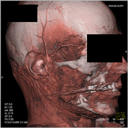 Various Renderings of Facial Region - CTisus CT Scan