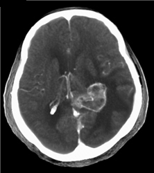 Astrocytoma - CTisus CT Scan