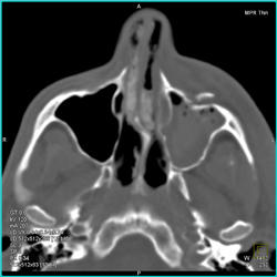 Fractured Wall of Sinus With Bleed - CTisus CT Scan