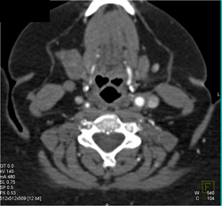 Takayasu's Arteritis Right Carotid Artery - CTisus CT Scan