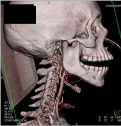 Normal Carotid Artery - CTisus CT Scan