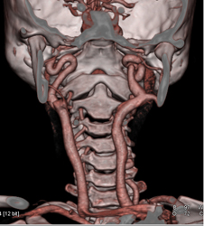 Normal Carotid Artery - CTisus CT Scan