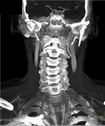 Normal Carotid Artery - CTisus CT Scan