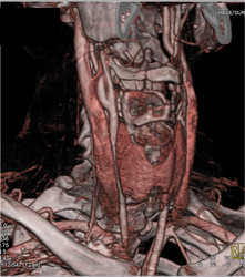 Normal Carotid Artery - CTisus CT Scan