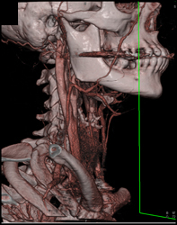 Normal Carotid Artery - CTisus CT Scan