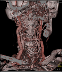 Normal Carotid Artery - CTisus CT Scan