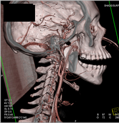 Normal Carotid Artery - CTisus CT Scan