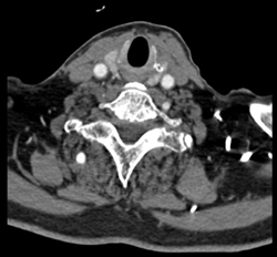 Carotid Artery Stenosis - CTisus CT Scan