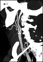 Carotid Artery Stenosis - CTisus CT Scan