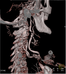 Carotid Artery Stenosis - CTisus CT Scan